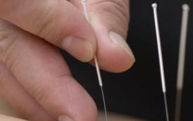 acupuncture-770x560.jpg